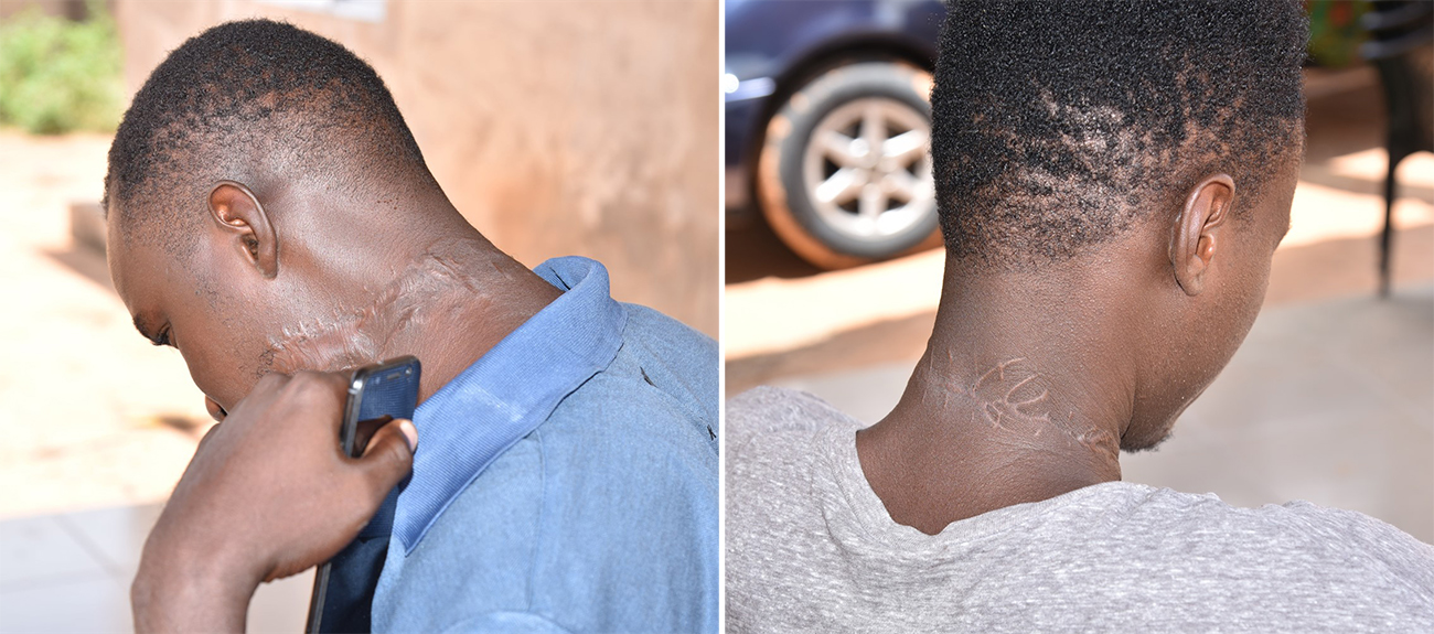 (자료사진) 나이지리아의 이슬람 극단주의 무장단체인 보코하람의 공격으로 목에 흉터가 남은 나이지리아 남성들.